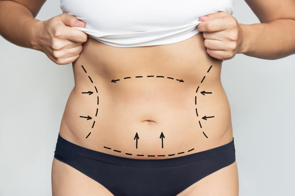 Best Liposuction Surgeon in Delhi