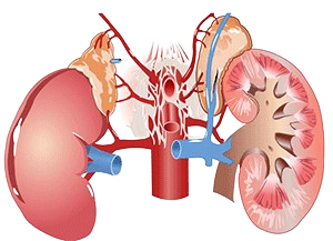 Kidney Stone Removal Surgery treatment in Delhi