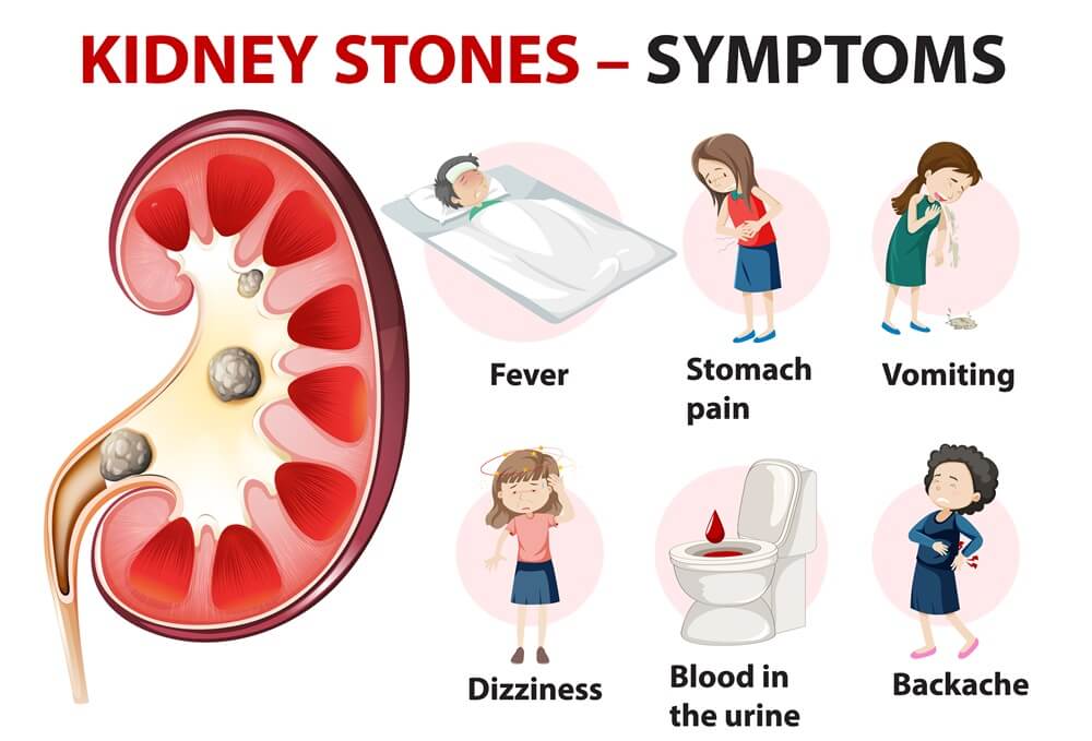 Symptoms of kidney stone 