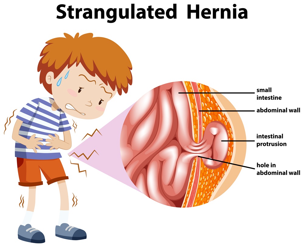 Laparoscopic Hernia Surgery