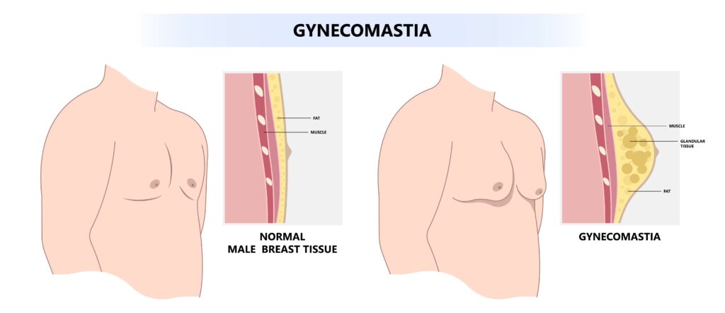 Gynecomastia Surgery