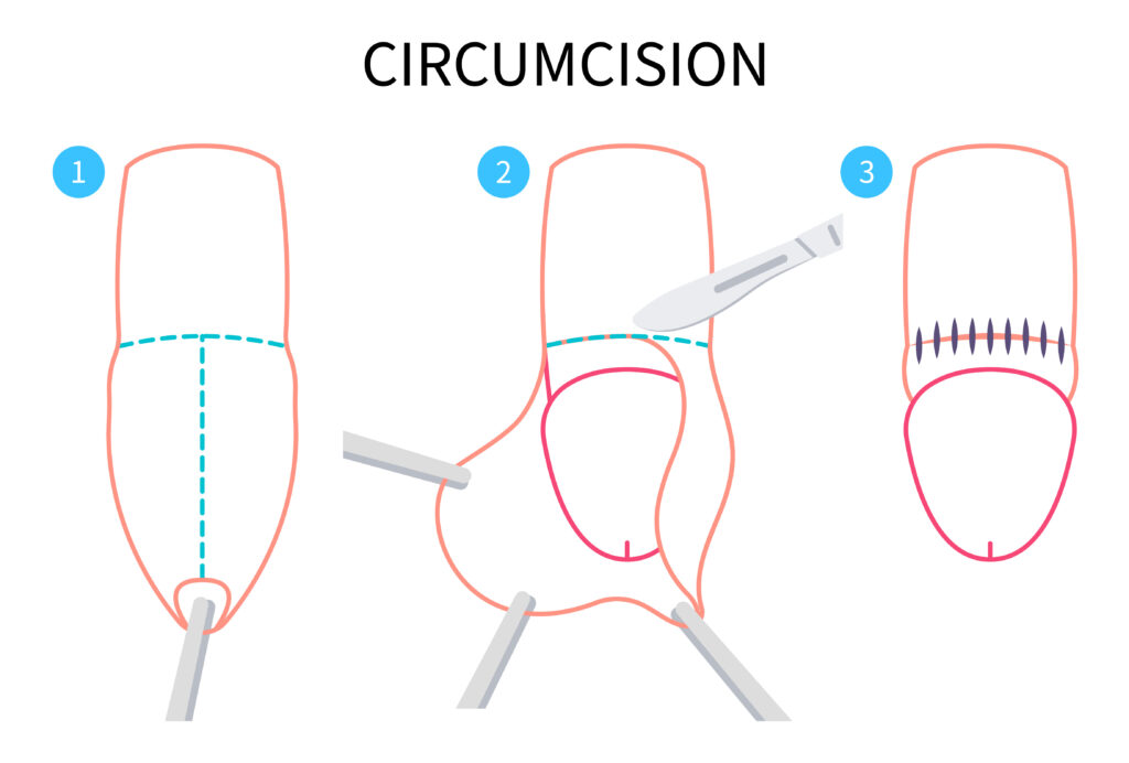 Stapler Circumcision Surgery