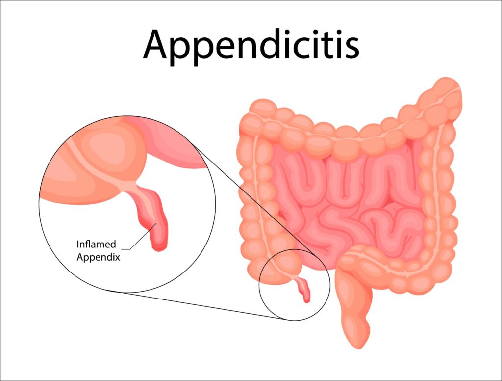 Appendicitis Surgery