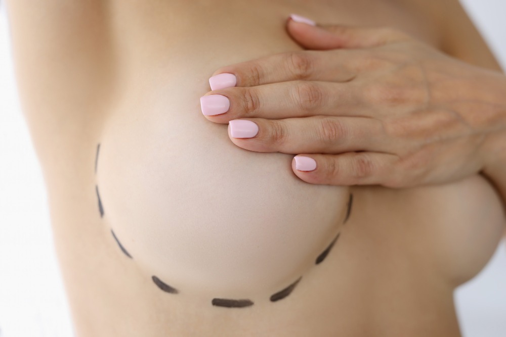 Breast Reduction Surgery