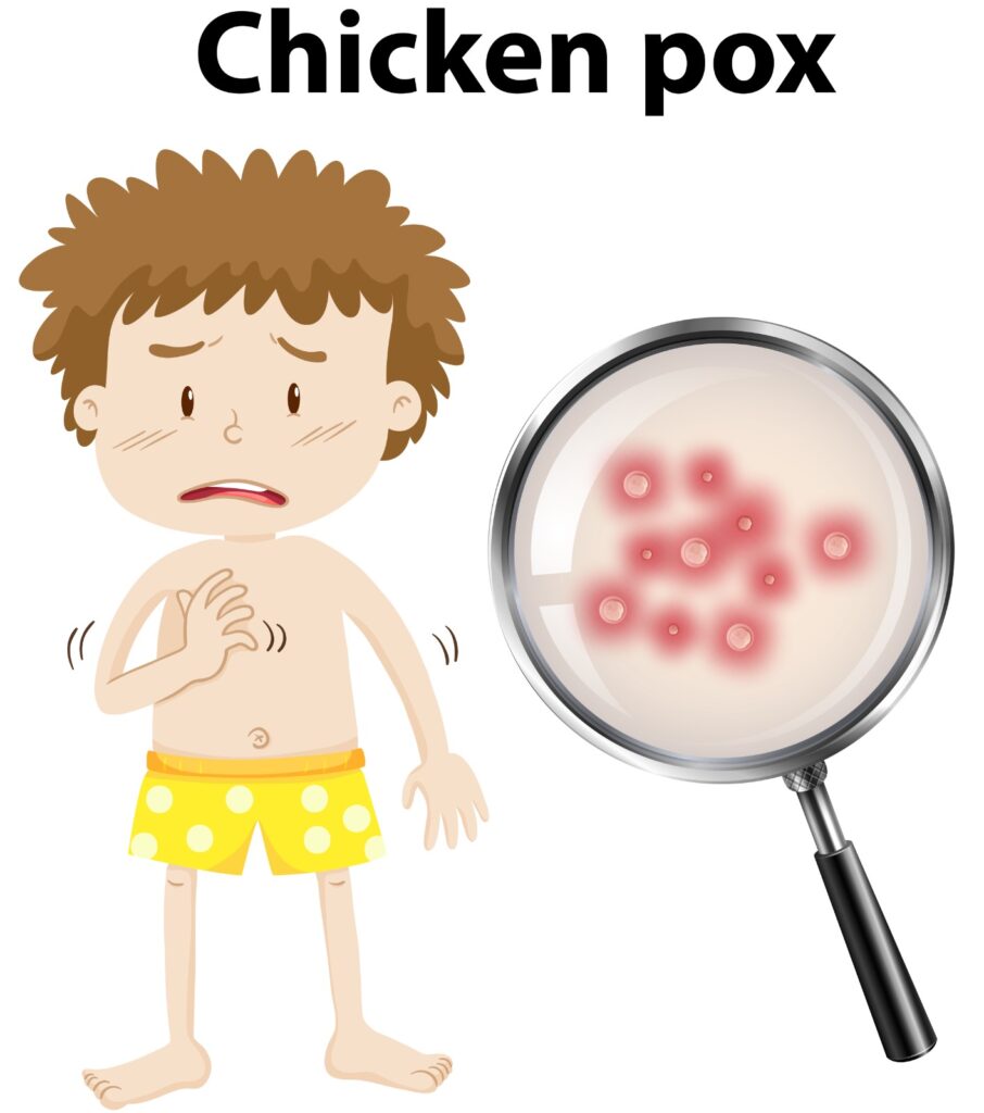 ChickenPox Treatment