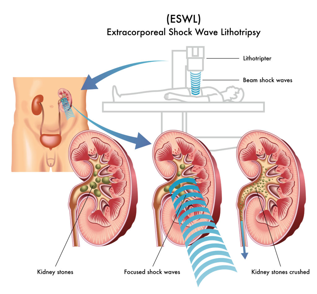 Extracorporeal Shock Wave Lithotripsy (ESWL) Procedure