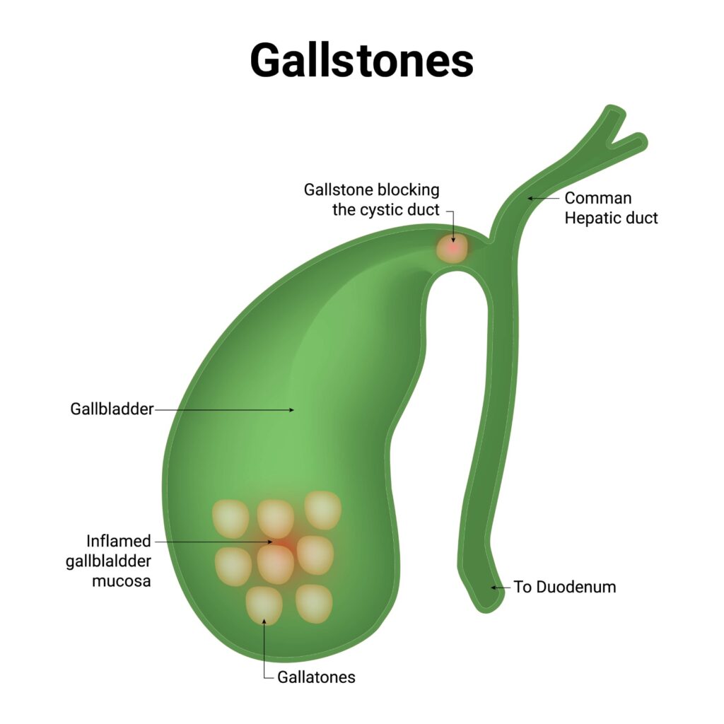 Gallstone Surgery