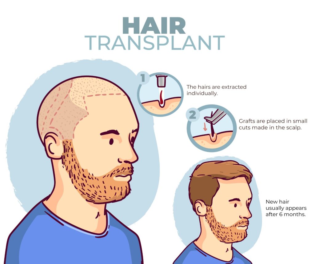 Hair Transplant Surgery