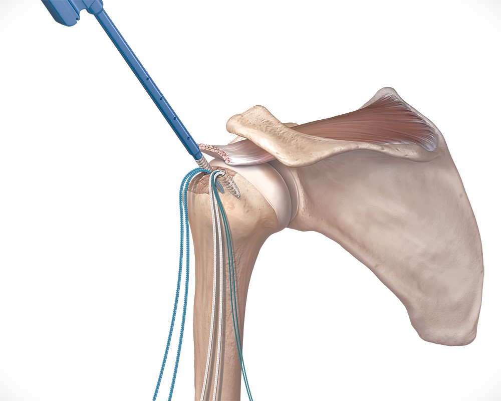 rotator cuff repair