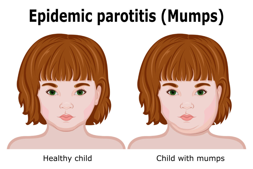 Mumps Treatment