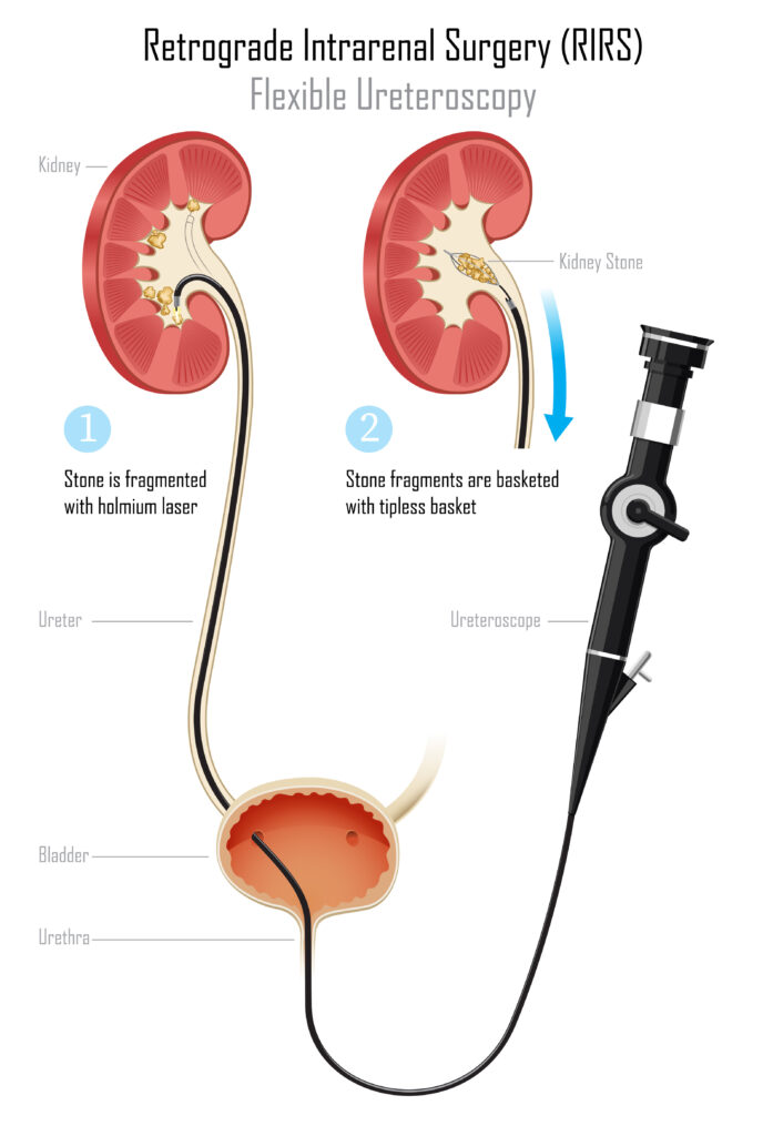 Retrograde Intrarenal Surgery (RIRS)