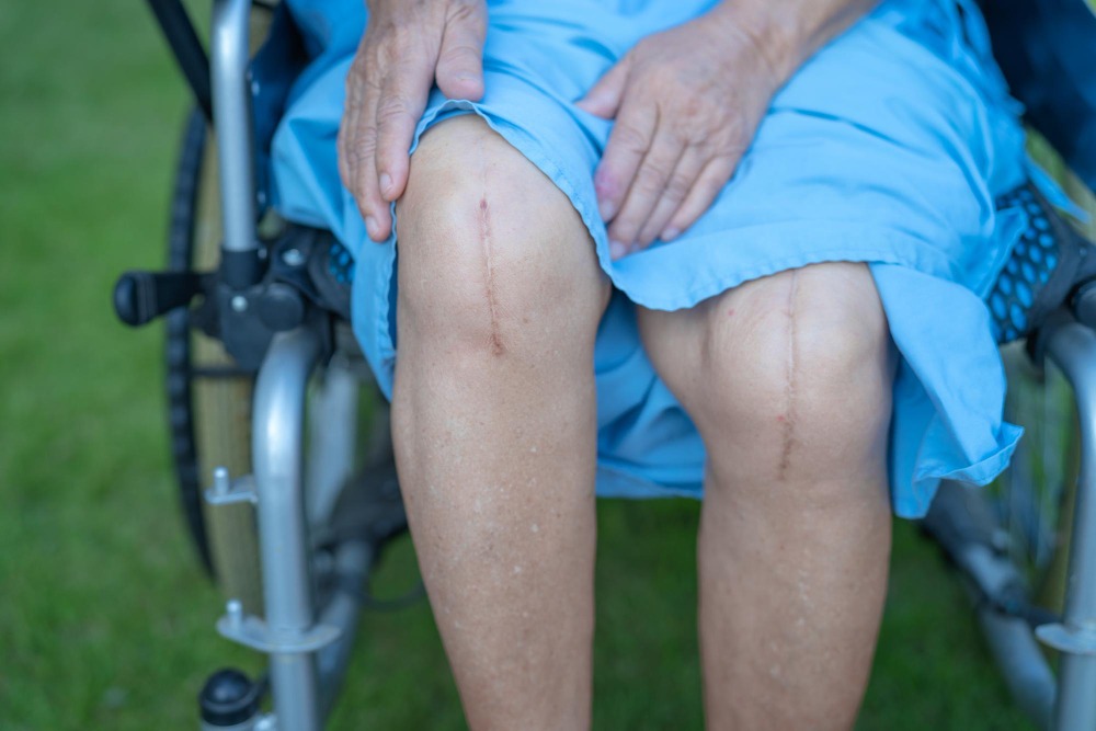 Total Knee Replacement