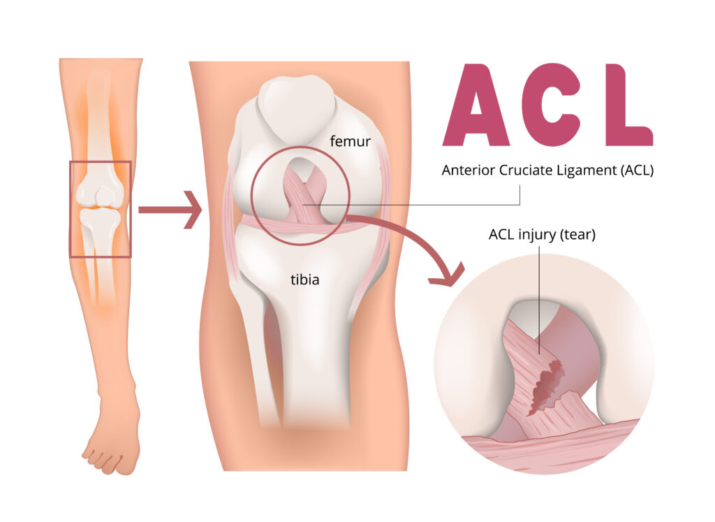 ACL Tear Surgery