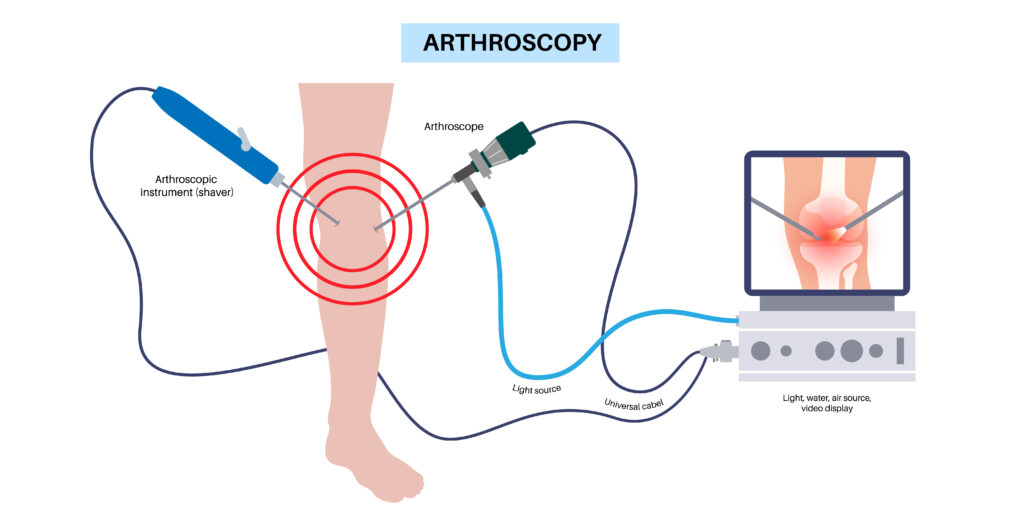 Knee joint arthroscopy