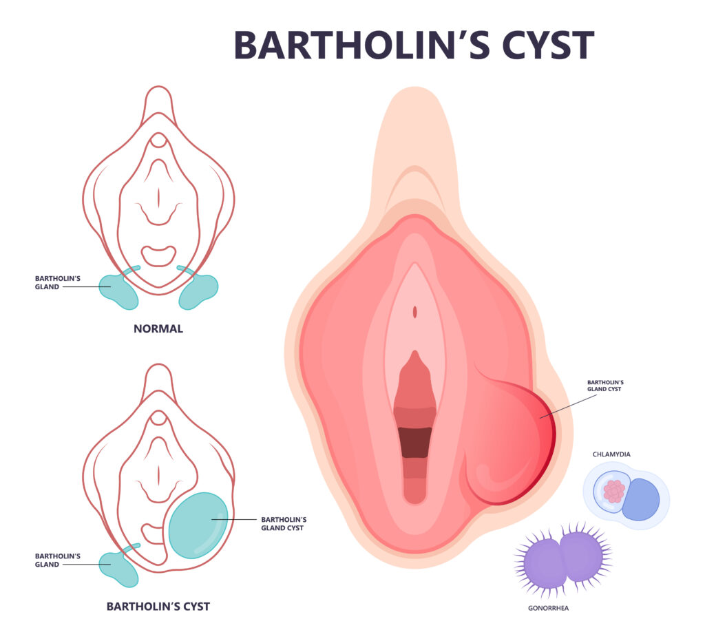 bartholin cyst