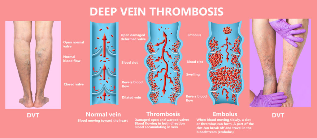 deep vein thrombosis treatment