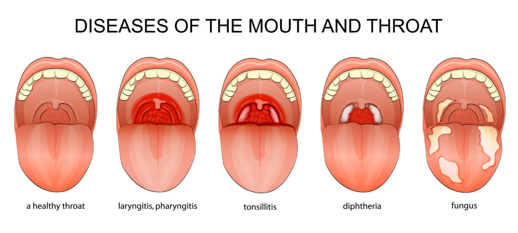 Diphtheria Treatment