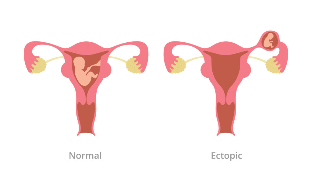 ectopic pregnancy procedure