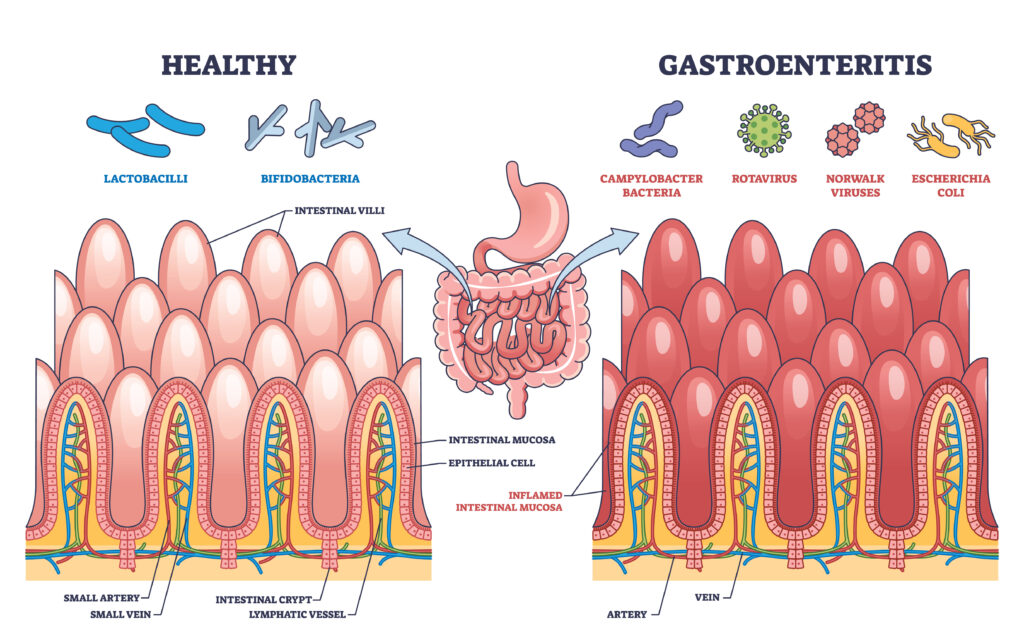 gastroenteritis treatment