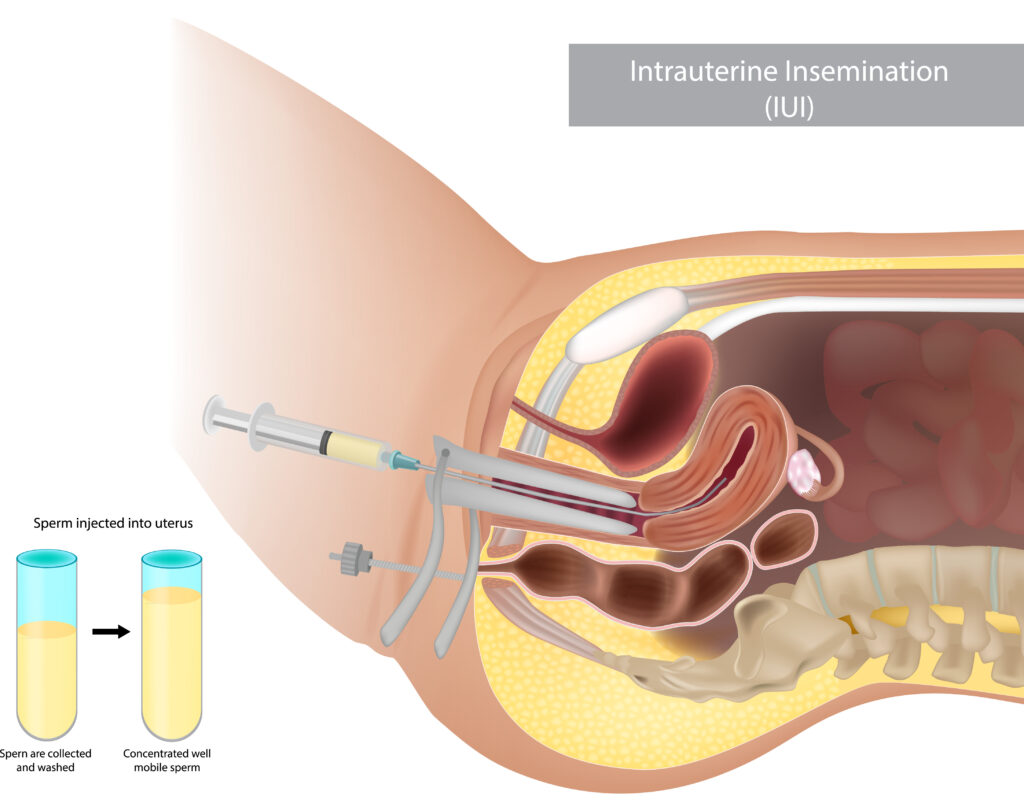 iui treatment