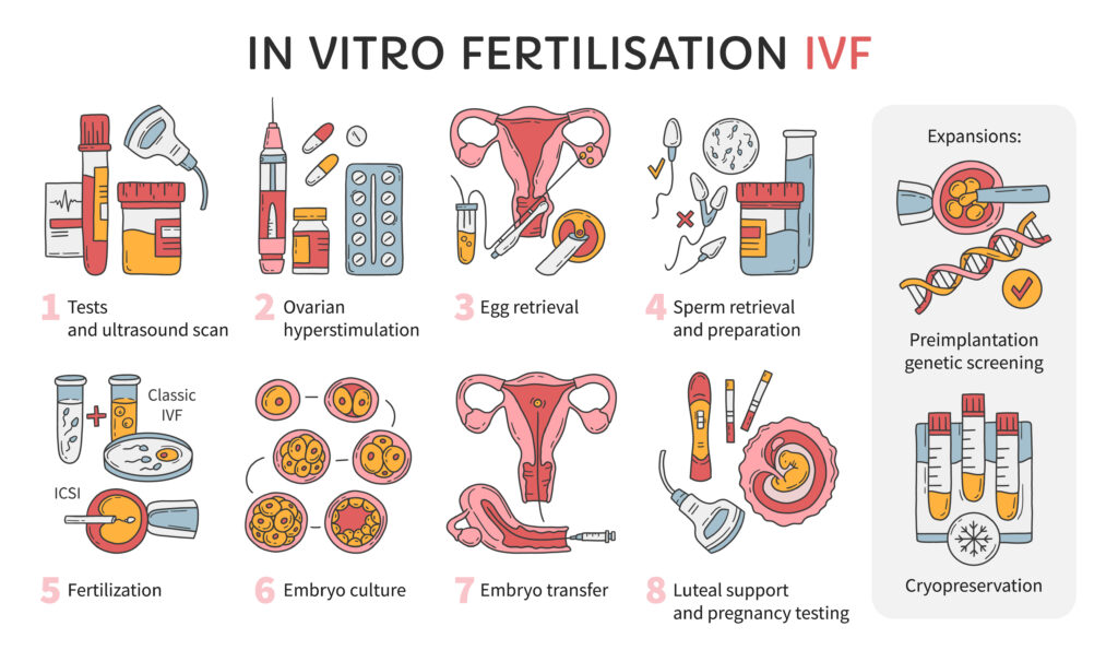 IVF