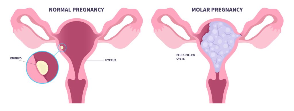 molar pregnancy procedure