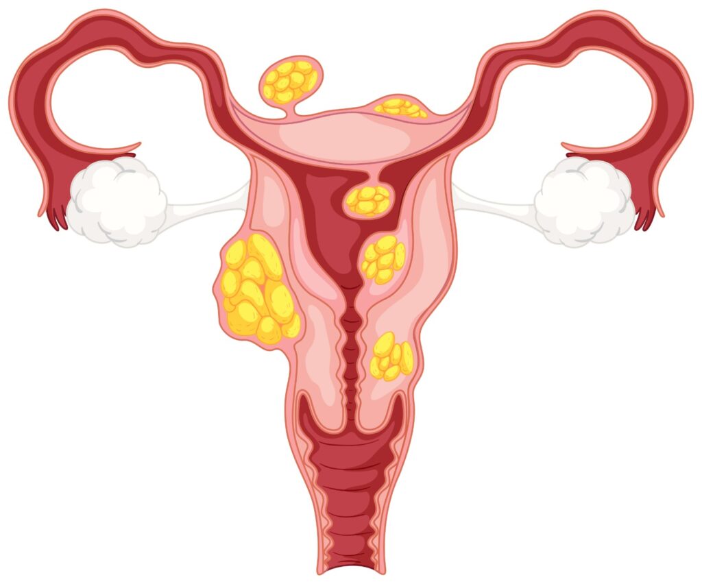 myomectomy procedure