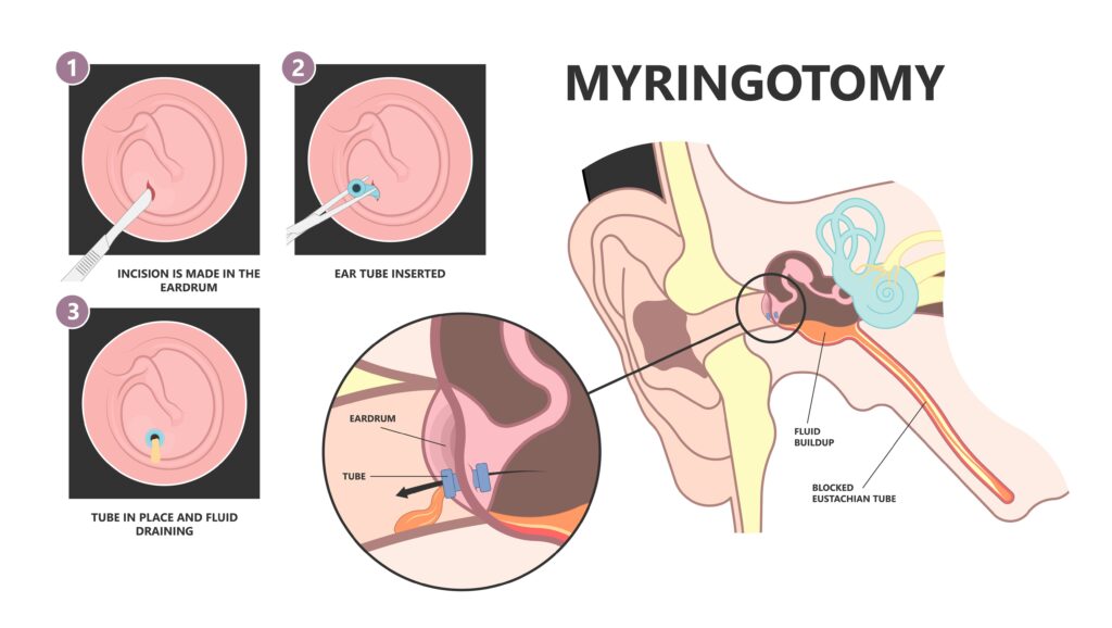 Myringotomy Surgery