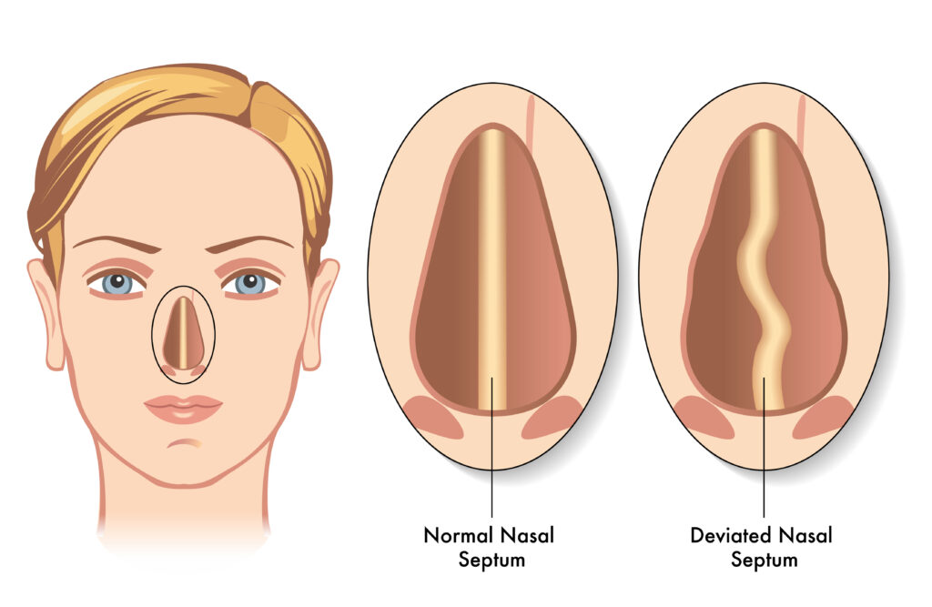 Nasal Septum Deviation Surgery (Septoplasty)