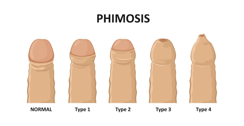 Phimosis Treatment