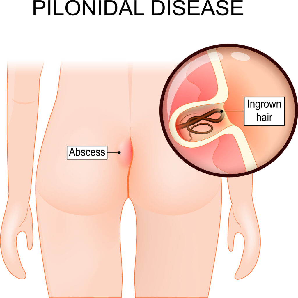 pilonidal sinus surgery