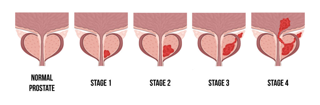 prostate enlargement