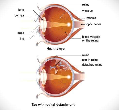 retinal detachment