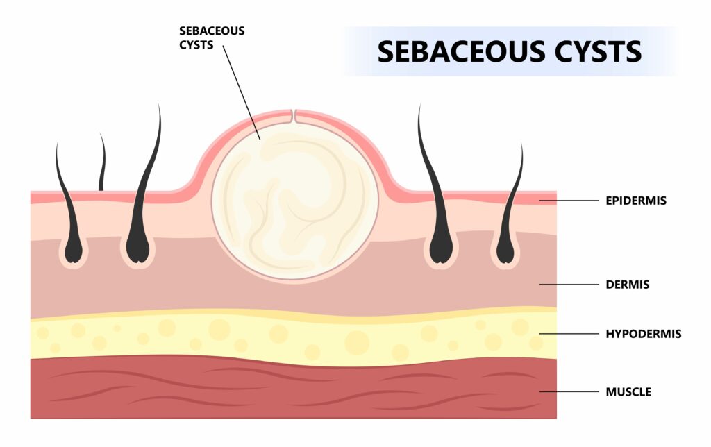 Sebaceous Cyst Surgery