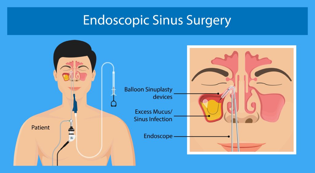 Sinus surgery