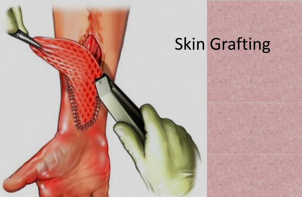 Skin Grafting Surgery