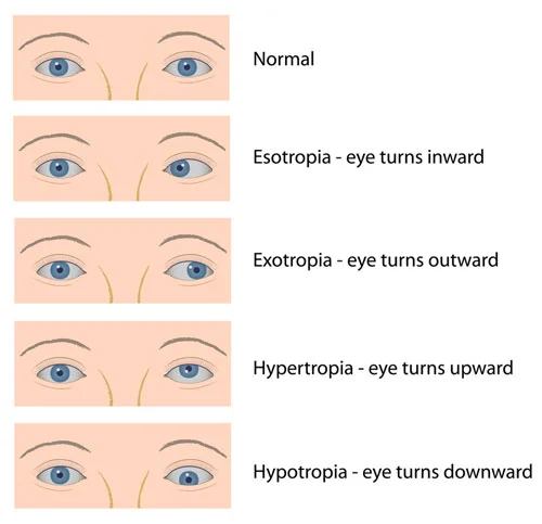 squint surgery