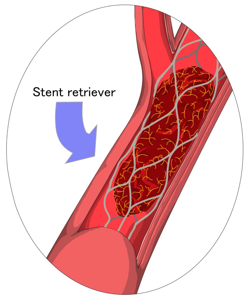 thrombectomy surgery