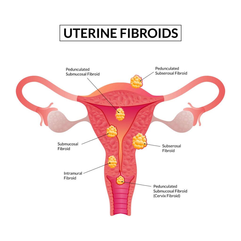 Uterine fibroids surgery