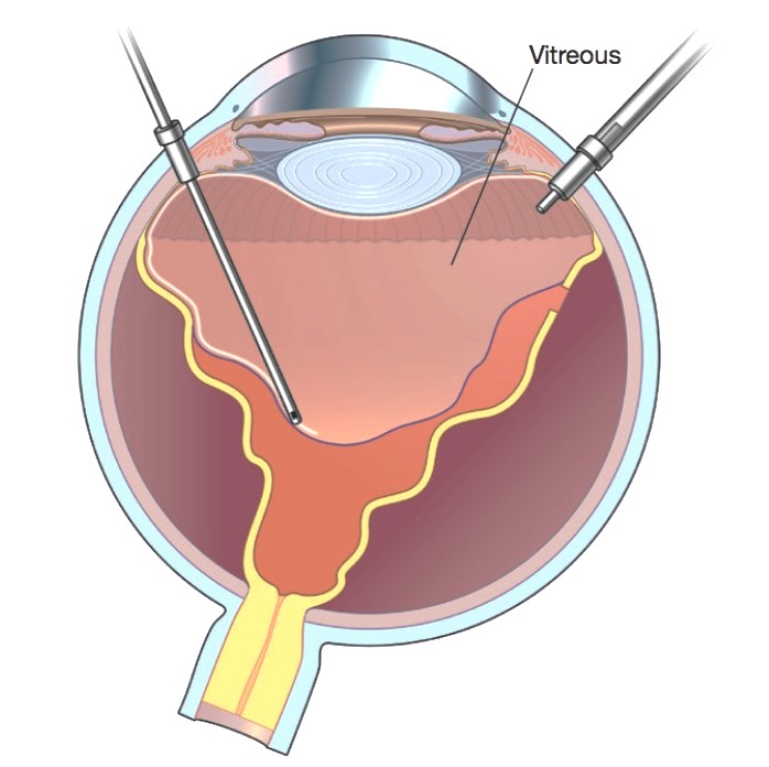 vitrectomy Surgery