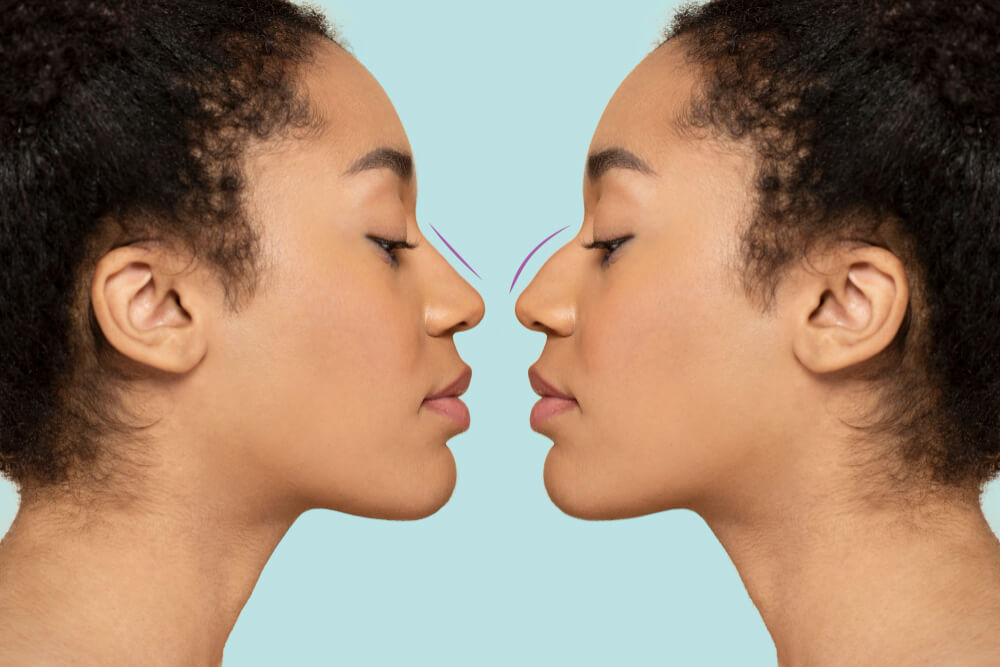 Rhinoplasty Surgery in Delhi NCR