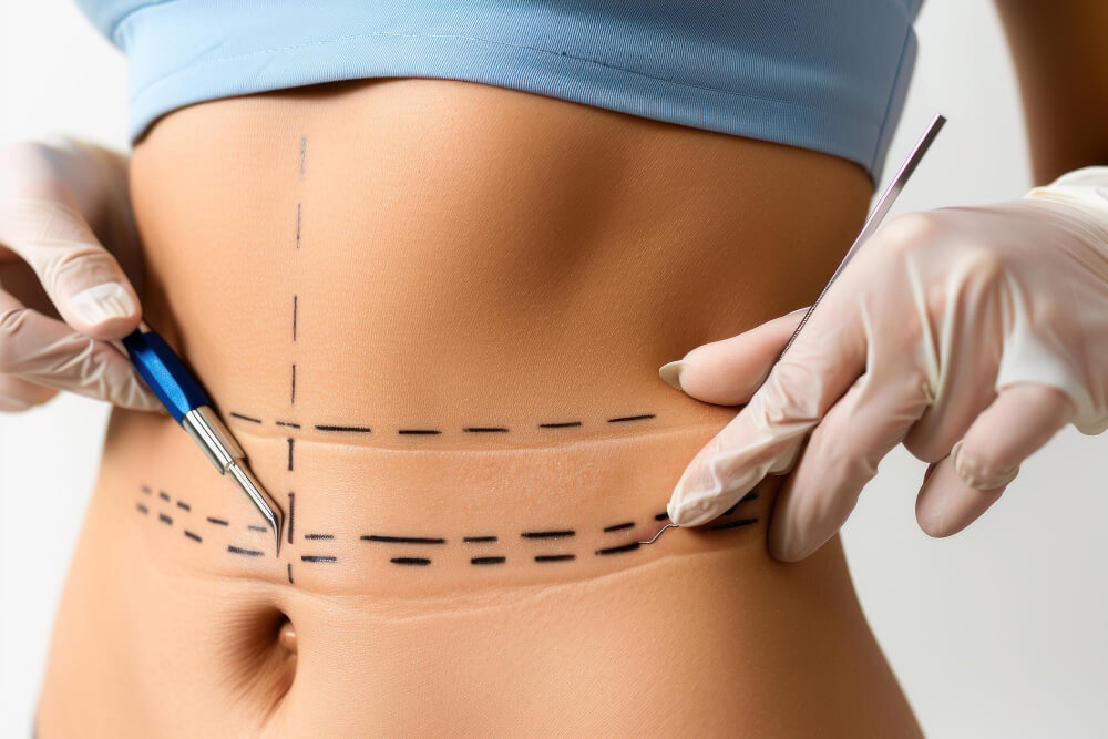 Cost of Liposuction In Delhi