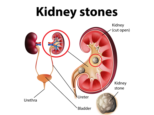 Kidney Stone Removal Surgery treatment in Delhi