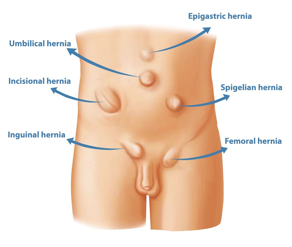 laparoscopic Hernia treatment in Delhi