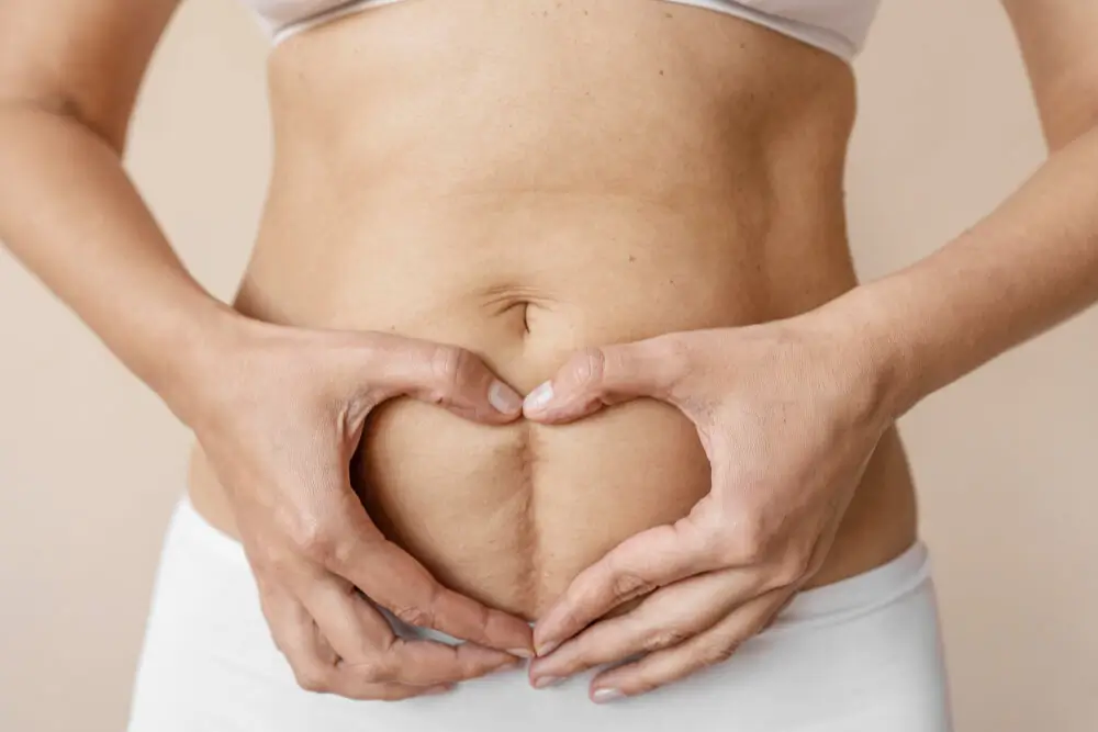 Everything You Need to Know About Liposuction Surgery