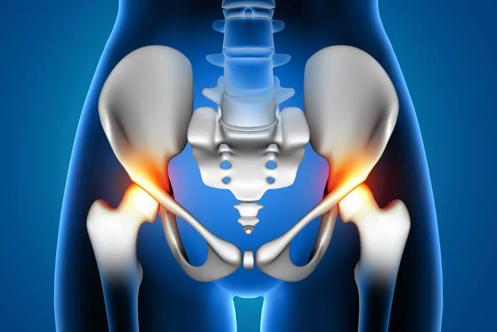 Complete Guide to Hip Replacement Surgery in Delhi: Costs & Care